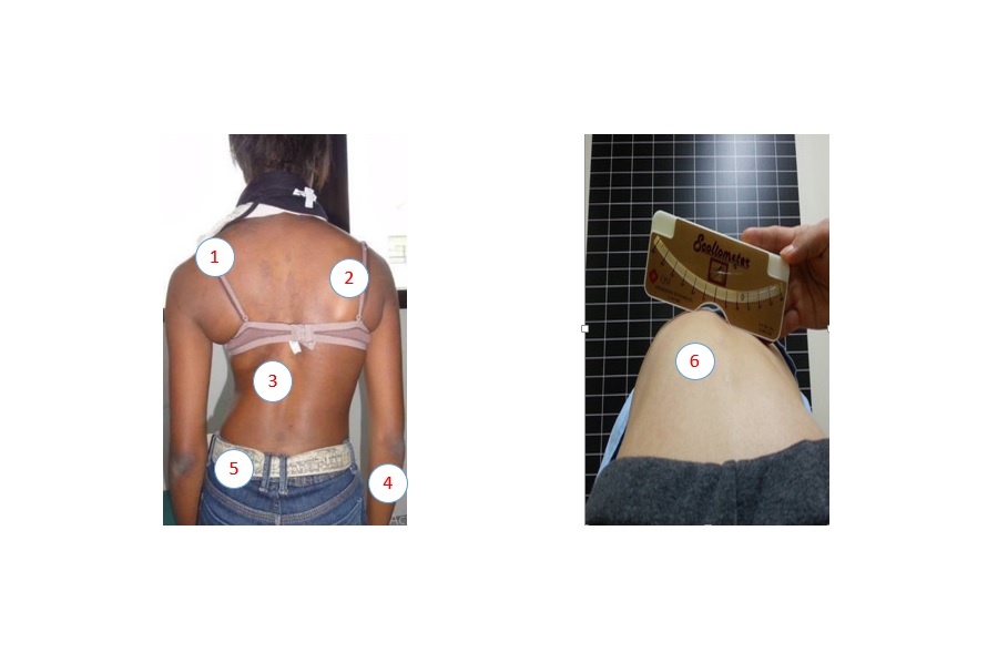 Dépistage de la scoliose/